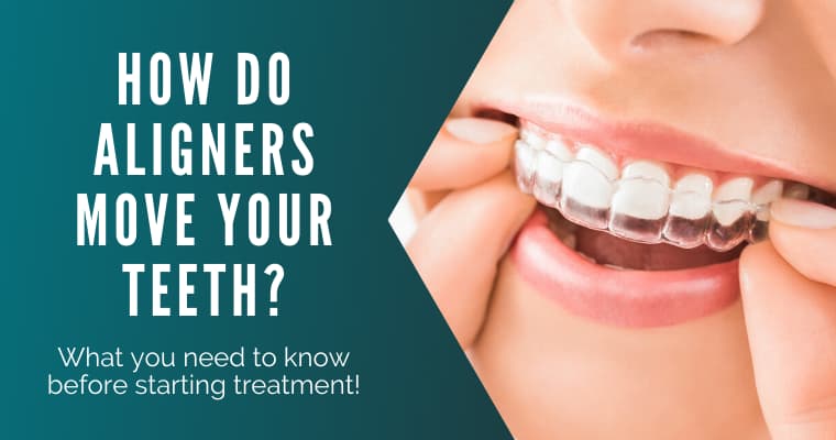 How clear aligners work