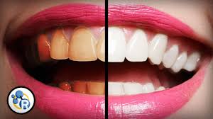 What's The Best Way To Whiten Teeth?